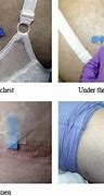 Image result for Hypodermoclysis