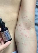Image result for Molluscum Contagiosum in Adults Scarring
