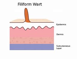 Image result for All the Various Types of Warts