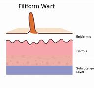 Image result for Filiform Wart On Forehead