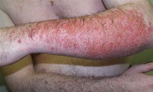 Image result for Dermatitis Skin Rash