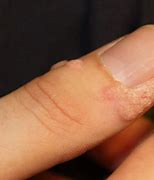 Image result for Beginning of Wart On Finger
