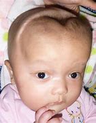 Image result for Hydrocephalus in Baby