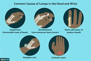Image result for Lump On Wrist Area