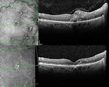 Image result for Retinal Cyst Oct