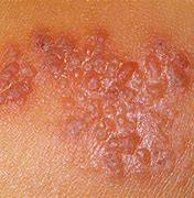 Image result for Itchy Skin Rash with Blisters