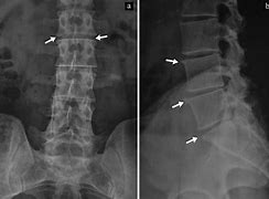 Image result for Osteophytes Lumbar Spine