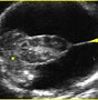 Image result for Hydranencephaly Fetal Ultrasound