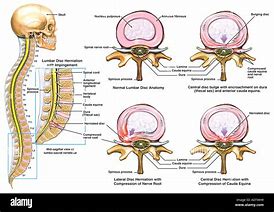 Image result for Types of Herniated Discs