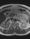 Image result for Stage 4 Renal Cell Carcinoma