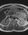 Image result for Renal Cell Carcinoma Metastasis