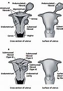 Image result for Pedunculated Uterine Fibroid