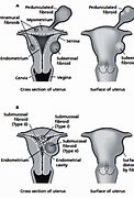 Image result for Anterior Uterine Fibroid