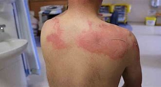 Image result for Itchy Burn