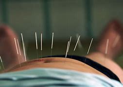 Image result for Acupuncture Wallpaper