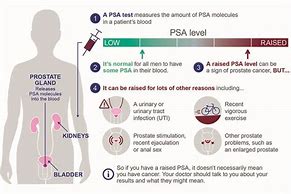 Image result for PSA and Prostate Cancer
