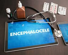 Image result for Encephalocele Symptoms