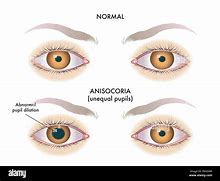 Image result for Pupilas Anisocoricas