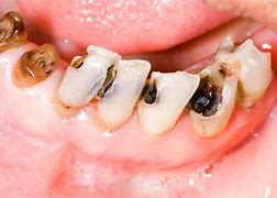 Image result for Gross Teeth