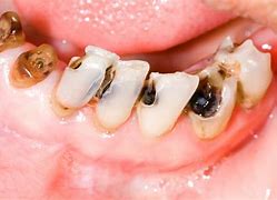 Image result for Rotten Teeth From Not Brushing
