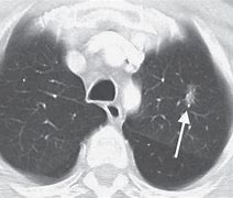 Image result for Left Upper Lobe Lung Nodule