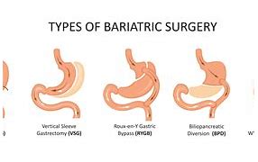 Image result for Gastric Sleeve Bariatric Surgery Procedure