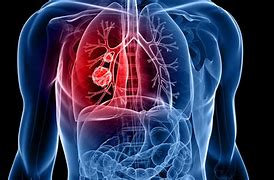 Image result for Lung Cancer Pictures