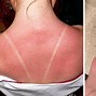 Image result for Sun Burn Rash/Bumps