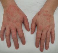 Image result for Eczema Skin Rash Pictures