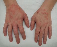 Image result for dermatitis