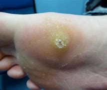 Image result for Wart Removal On Leg