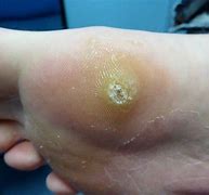 Image result for Diabetic Plantar Warts On Feet