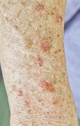 Image result for Actinic Keratosis Leg