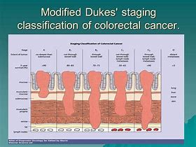 Image result for Colon Polyps Colonoscopy