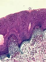 Image result for Molluscum Contagiosum Virus Lesions