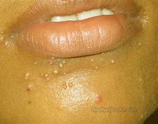 Image result for Molluscum Contagiosum Histology