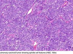 Image result for Carcinoid Tumor Histology