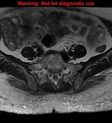 Image result for Cervical Spine Tumor