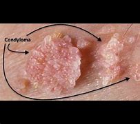 Image result for Excision Condyloma