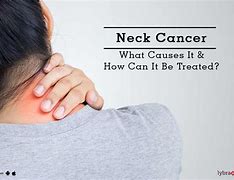 Image result for Cancer Tumors On Neck