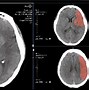 Image result for Non Calcified Lung Nodule