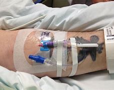 Image result for Bard Provena Midline Catheter