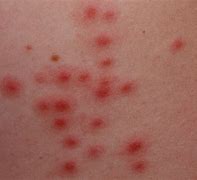 Image result for Skin Infection Folliculitis