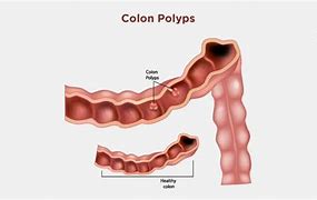 Image result for Small Colon Polyp