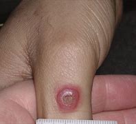 Image result for ORF Lesion