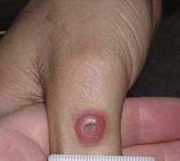 Image result for ORF Lesion