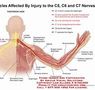 Image result for C5 C6 Nerve Compression Symptoms