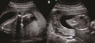 Image result for Second-Trimester Sirenomelia