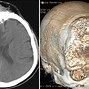 Image result for Meningioma Radiology