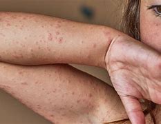 Image result for Skin Reaction Allergies